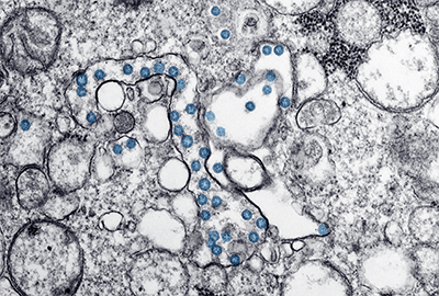 Transmission electron microscopic image of an isolate from the first U.S. case of COVID-19 Transmission electron microscopic image of an isolate from the first U.S. case of COVID-19